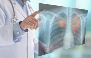 Low-Dose CT Lung Cancer Screening